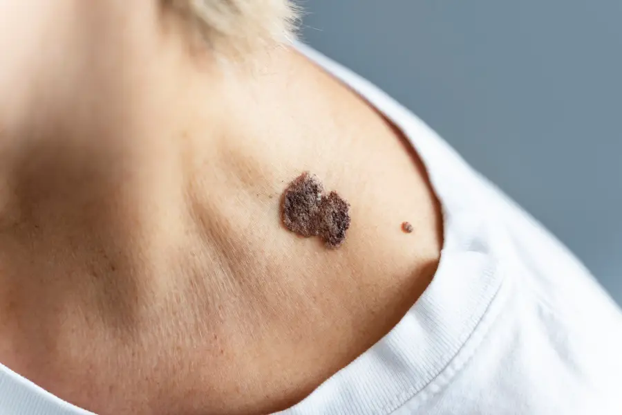 Close up patient with skin disease